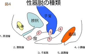 子宮 脱 手術 後